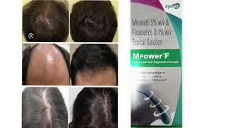 Mpower F Topical Solution Minoxidil 5 wv amp Finasteride 01 wv Topical Solution [upl. by Eugenides]