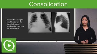 Consolidation – Radiology  Lecturio [upl. by Mars426]