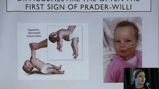 Diagnosing PraderWilli Syndrome [upl. by Eiralam]