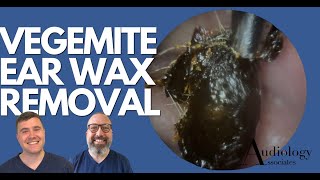 quotVEGEMITEquot EAR WAX REMOVAL  EP885 [upl. by Enoek]