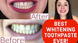 How I Whitened My Teeth in 14 Days [upl. by Harim927]