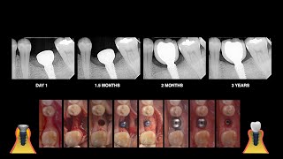 MARGINAL BONE GROWTH AND NO LOSS [upl. by Kaylil31]