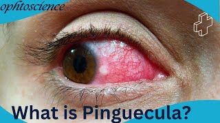 what is pinguecula symptoms sign treatment preventions [upl. by Emera334]