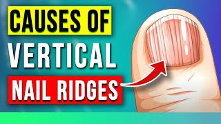 The SHOCKING Causes of VERTICAL RIDGES On Your Nails [upl. by Anaj207]