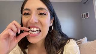 TMJ Splint Therapy 1 month update [upl. by Ericha330]