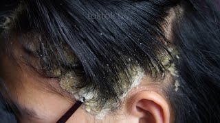 Dandruff scratching removal on head using black combing407 [upl. by Estelle]