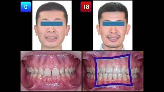 Solving Deep Bite with Retroclined Upper Incisors amp U7 Crossbite｜【Chris Chang Ortho】CC773 [upl. by Eirrot]