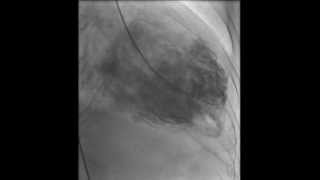 HAKIMVISTA MIOCARDIOPATIA DILATADA VENTRICULOGRAMA CON TROMBO INTRAVENTRICULAR [upl. by Shaya576]