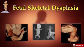 Fetal Skeletal Dysplasia [upl. by Othe]