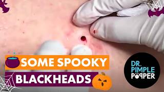 Some Spooky Blackheads [upl. by Rachele]