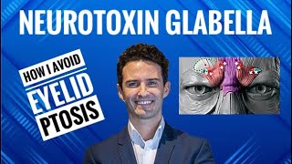 Injectors guide  Neurotoxin amp Glabella [upl. by Underwood962]