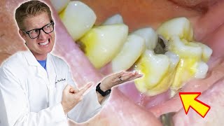 Patients Tooth FALLS OUT During Deep Cleaning TONS OF PLAQUE TARTAR amp GROSS Bacteria Removed [upl. by Vergos]