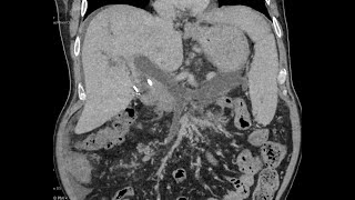 Portal  splenic  superior mesenteric vein thrombosis extensive  CT [upl. by Nahtaoj]