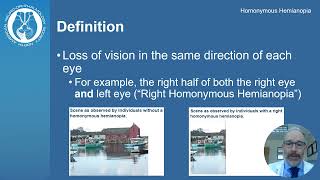 Understanding Homonymous Hemianopia Causes Symptoms and Treatment  Visual Impairment Explained [upl. by Bari426]