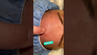 REMOVAL OF FOREHEAD OSTEOMA  DR TANVEER JANJUA NEW JERSEY [upl. by Marylee]