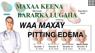 PITTING EDEMA  MAXAA KEENA BARARKA LUGAHA SIDA LOO DAAWEEYO [upl. by Meletius]