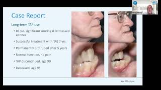 New AM Aligner Case Report [upl. by Downall]