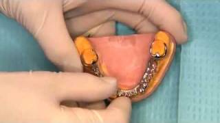 V2551  Predictable Removable Partial Dentures [upl. by Donela932]