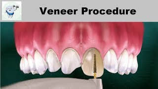 Dental Veneers Procedure Step by step [upl. by Assirual]