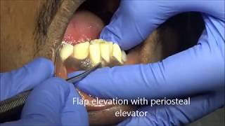 Supernumerary tooth extaction using forceps [upl. by Harret]