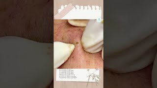 Big Cystic Acne Blackheads Extraction Blackheads amp Milia Whiteheads Removal Pimple Popping shorts [upl. by Hermes]