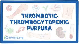 Thrombotic thrombocytopenic purpura NORD [upl. by Rabma]