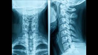 cervical spine intervertebral discs retropharyngeal fat stripe and posterior ororpharyngeal wall [upl. by Ayaladnot]