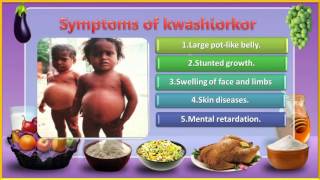 04 Nutrition and their Deficiency Diseases 5th evs [upl. by Laehcim]