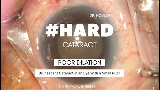 Hard Cataract in an Eye with a MidDilating Pupil [upl. by Colly398]