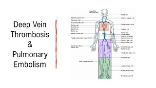 Venous Thromboembolic Disease DVT and PE [upl. by Elidad]