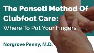 The Ponseti Method Of Clubfoot Care׃ Where To Put Your Fingers [upl. by Anecusa158]