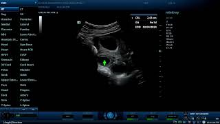 Dichorionic twins and two corpus luteum cysts Diagnostic ultrasound cases [upl. by Anerb40]