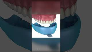 Veneers Dental Procedure [upl. by Luzader]