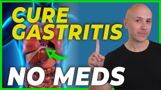 HOW to CURE GASTRITIS without medications  DR CARLOS [upl. by Walsh850]