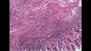 Histopathology Colon Amebiasis [upl. by Atelokin]