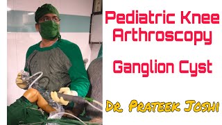 Arthroscopy in 6 year old child  Pediatric Knee Arthroscopy  ACL Ganglion Cyst  Dr Prateek Joshi [upl. by Nner]