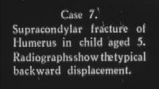 Recent advances in fracture treatment Part 5 c1932 [upl. by Howlond]