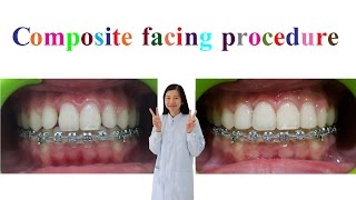 Composite facing procedure [upl. by Swayne]