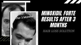 Minoxidil Regroe Forte 6  Results After 3 months  Hair Loss Solution [upl. by Aineles]