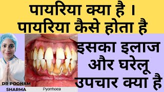 पायरिया क्या है  पायरिया कैसे होता है  पायरिया का इलाज और घरेलु उपचार  Treatment Of Pyorrhea [upl. by Alis908]