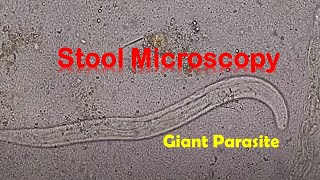 Stool under the Microscope showing Parasite Strongyloides stercoralis [upl. by Stanislas]