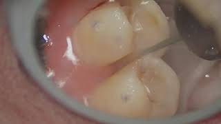 Maxillary premolar crown preparationproximal reduction under mirror view [upl. by Yadsnil726]