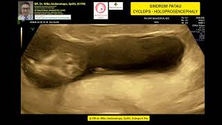 Sindrom Patau Holoprosencephaly  Cyclops 13 weeks [upl. by Najram]