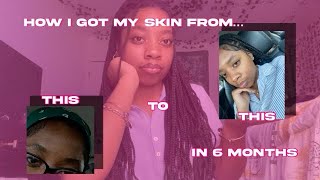 HOW I CLEARED MY SKIN IN LESS THAN SIX MONTHS🧼🚿 [upl. by Aspia850]