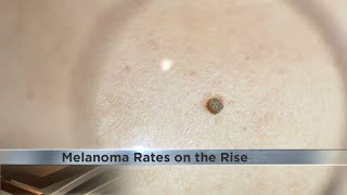 Melanoma rates are on the rise [upl. by Aicyla]