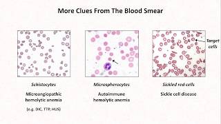 Anemia Lesson 4  Clues from the blood smear [upl. by Beaulieu]