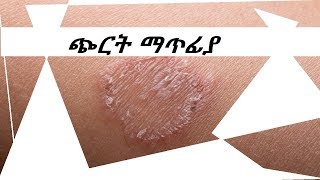 ጭርትን በተፈጥሯዊ መንገድ ማጥፊያget rid of Ringworm naturally [upl. by Ahcim701]