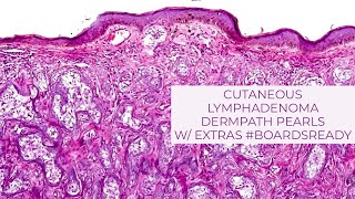 Cutaneous Lymphadenoma with extras Explained by a dermatopathologist Unk 17 Boardsready [upl. by Nyrrat55]