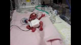 Baby B born at 22 weeks 6 days [upl. by Meagher]