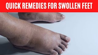 Home Remedies for Swollen Feet  Edema Remedy [upl. by Nosa346]